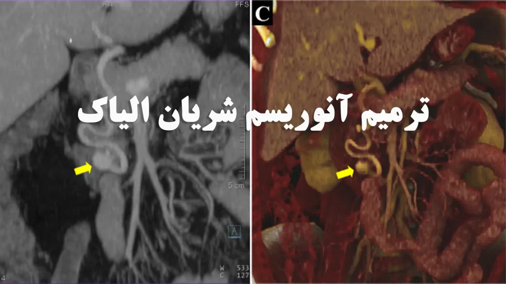 عمل جراحی آنوریسم آئورت شکمی به قطر هشت سانتی متر